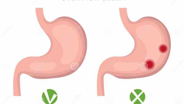 Диета при язве желудка и двенадцатиперстной кишки