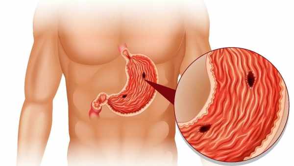 Не заметить сложно: 6 очевидных признаков, что у тебя язва желудка