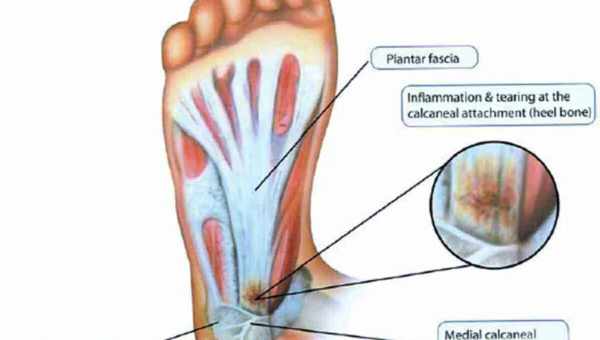 Пяточная шпора: что это такое, почему она появляется и как её лечить?