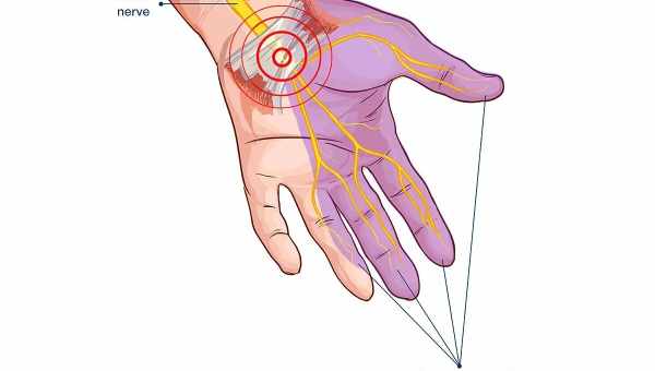 Туннельный синдром: почему возникает и что будет, если не лечить