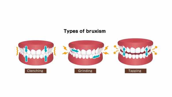 Что такое бруксизм: как скрежетание зубами портит наше здоровье