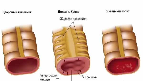 Причины выпадения прямой кишки у ребенка, симптомы, диагностика и лечение