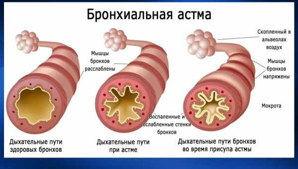 Причины возникновения бронхита у детей 2-3 лет, симптомы и лечение в домашних условиях