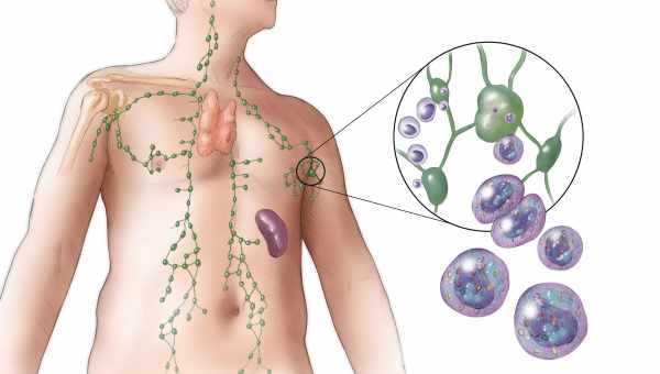 Симптомы лимфомы у детей, причины возникновения заболевания и особенности лечения