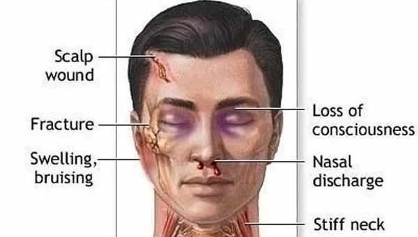 Последствия перелома черепа у детей до года и старше, симптомы и особенности лечения травмы