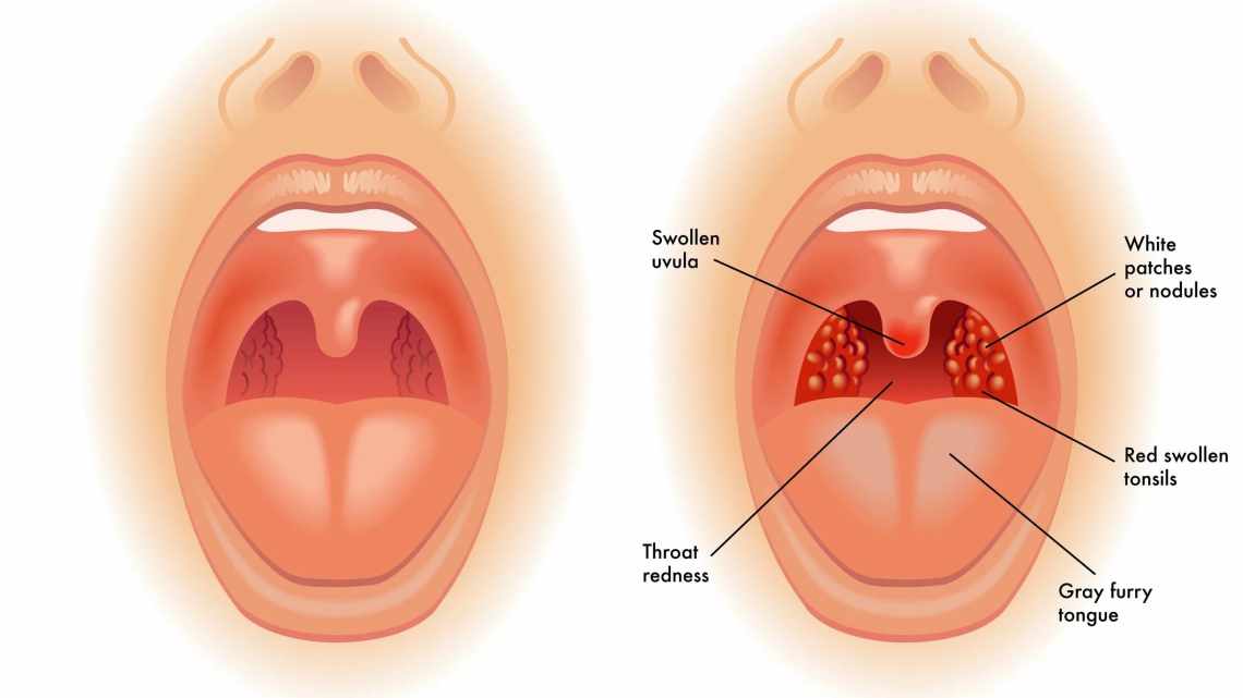 Симптомы и лечение бактериальной ангины у детей, профилактика заболевания