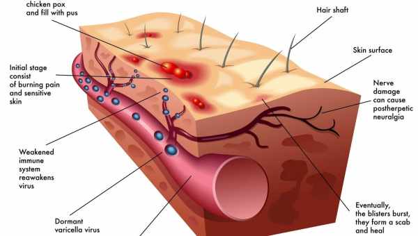 Симптомы опоясывающего лишая у детей, диагностика и схема лечения вируса герпеса
