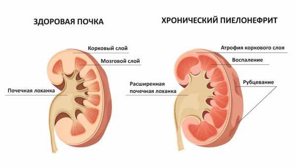 Симптомы гидронефроза почек у новорожденных и детей старше года, методы лечения и исход заболевания