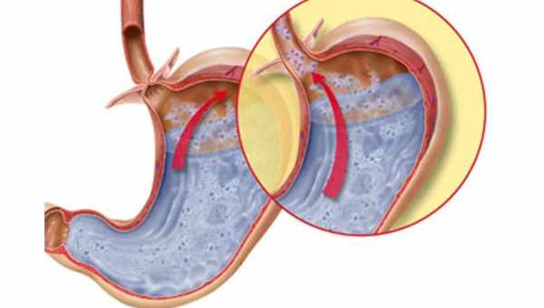 Что такое гастроэзофагеальный рефлюкс желудка и эзофагит: симптомы и лечение у грудничков и детей от года