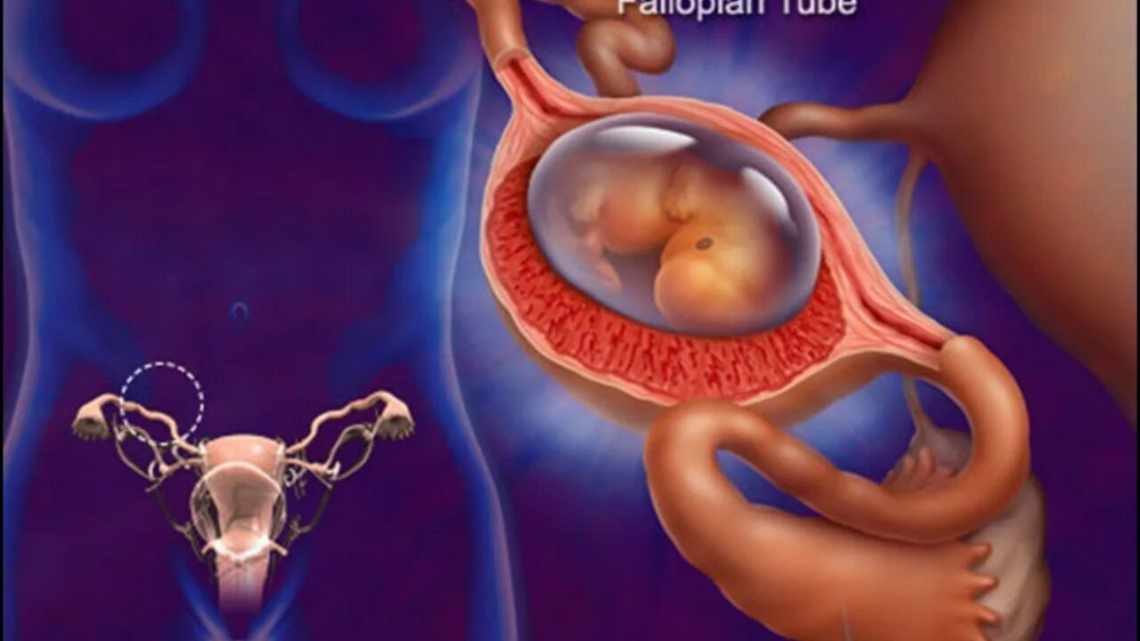 Не на месте: почему возникает внематочная беременность и чем она опасна