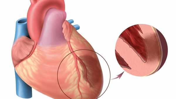 Для инфаркта миокарда нашли ещё один ген