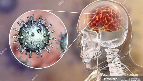 У вируса герпеса ищут связь с рассеянным склерозом