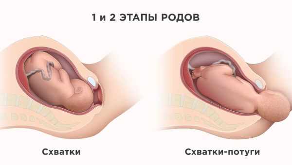 Чтобы избежать преждевременных родов, нужно успокоить иммунитет