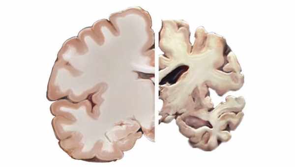 При болезни Альцгеймера мозг видит старое как новое