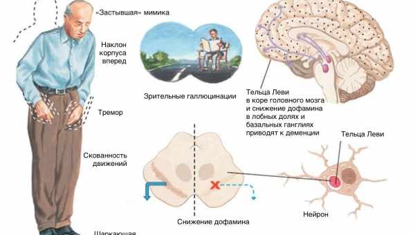 Болезнь Паркинсона остановили в мышах и человеческих нейронах